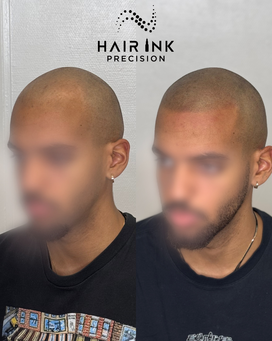 Résultat tricopigmentation