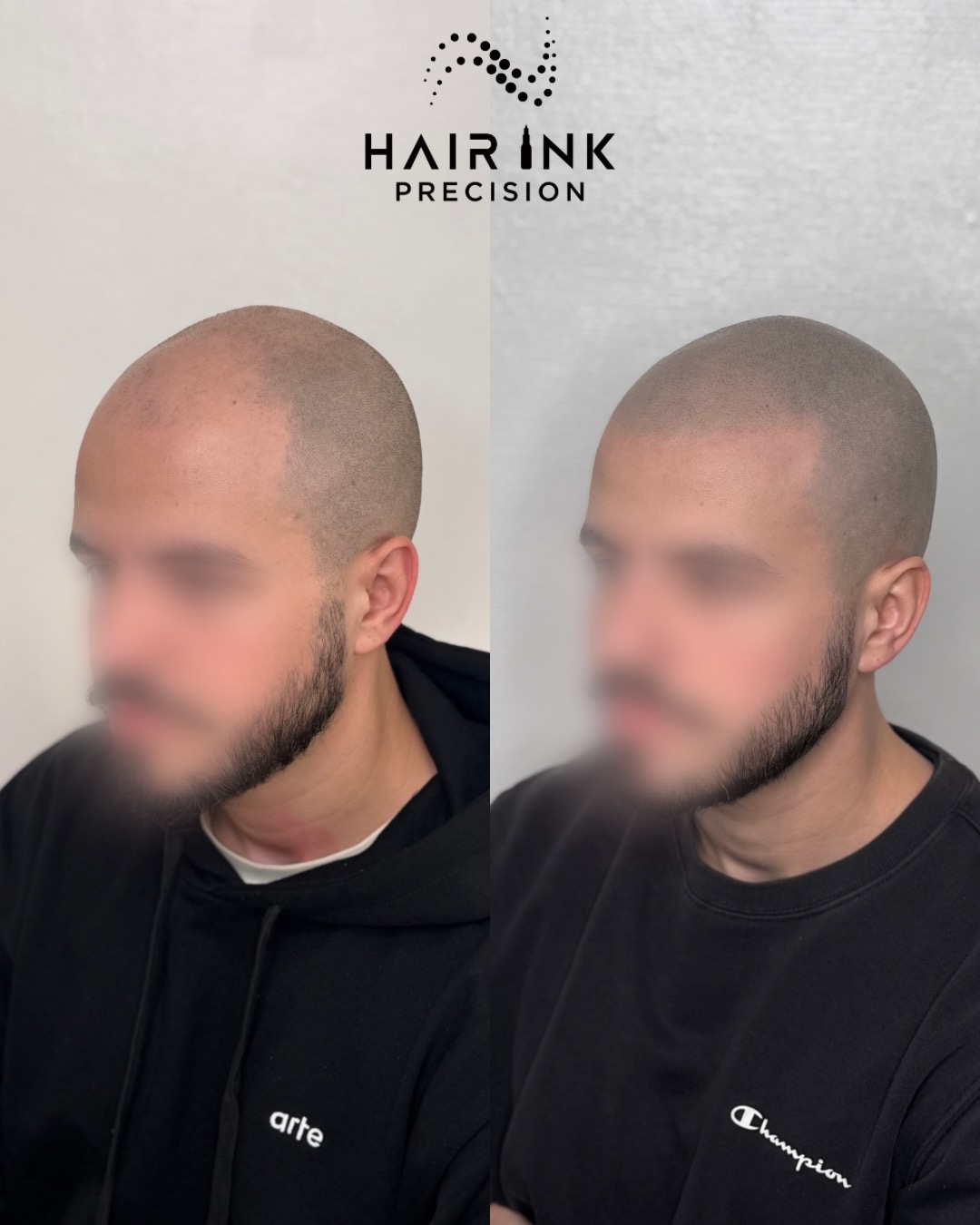 Résultat tricopigmentation