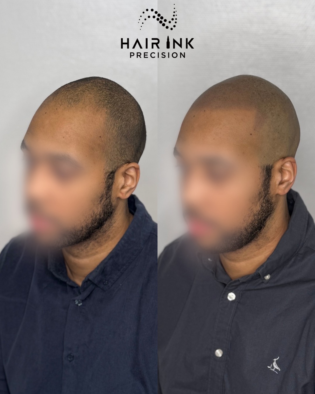 Résultat tricopigmentation