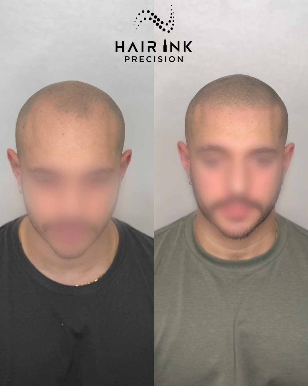 Résultat tricopigmentation