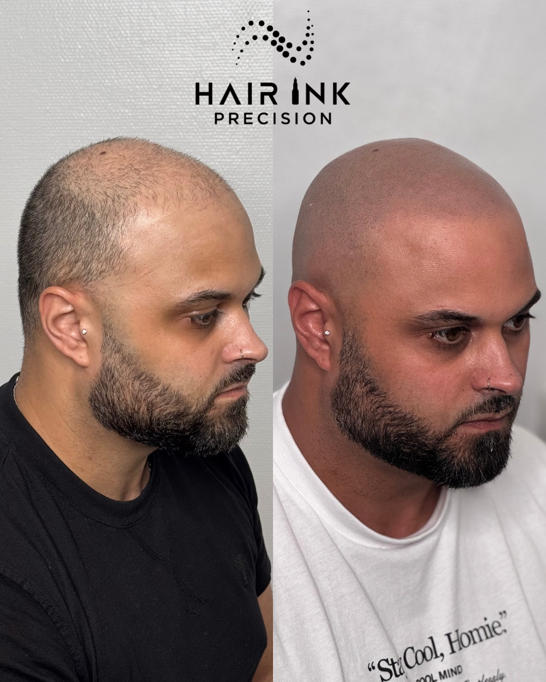 Résultat tricopigmentation