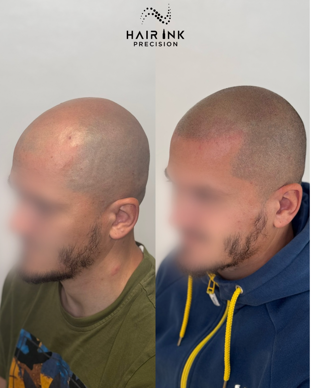 Résultat tricopigmentation