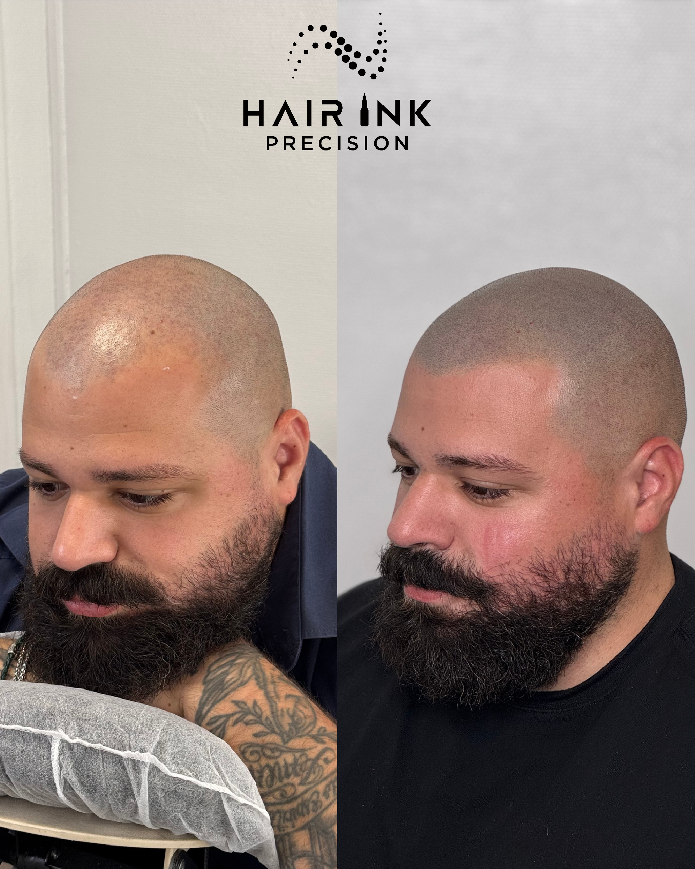 Résultat tricopigmentation