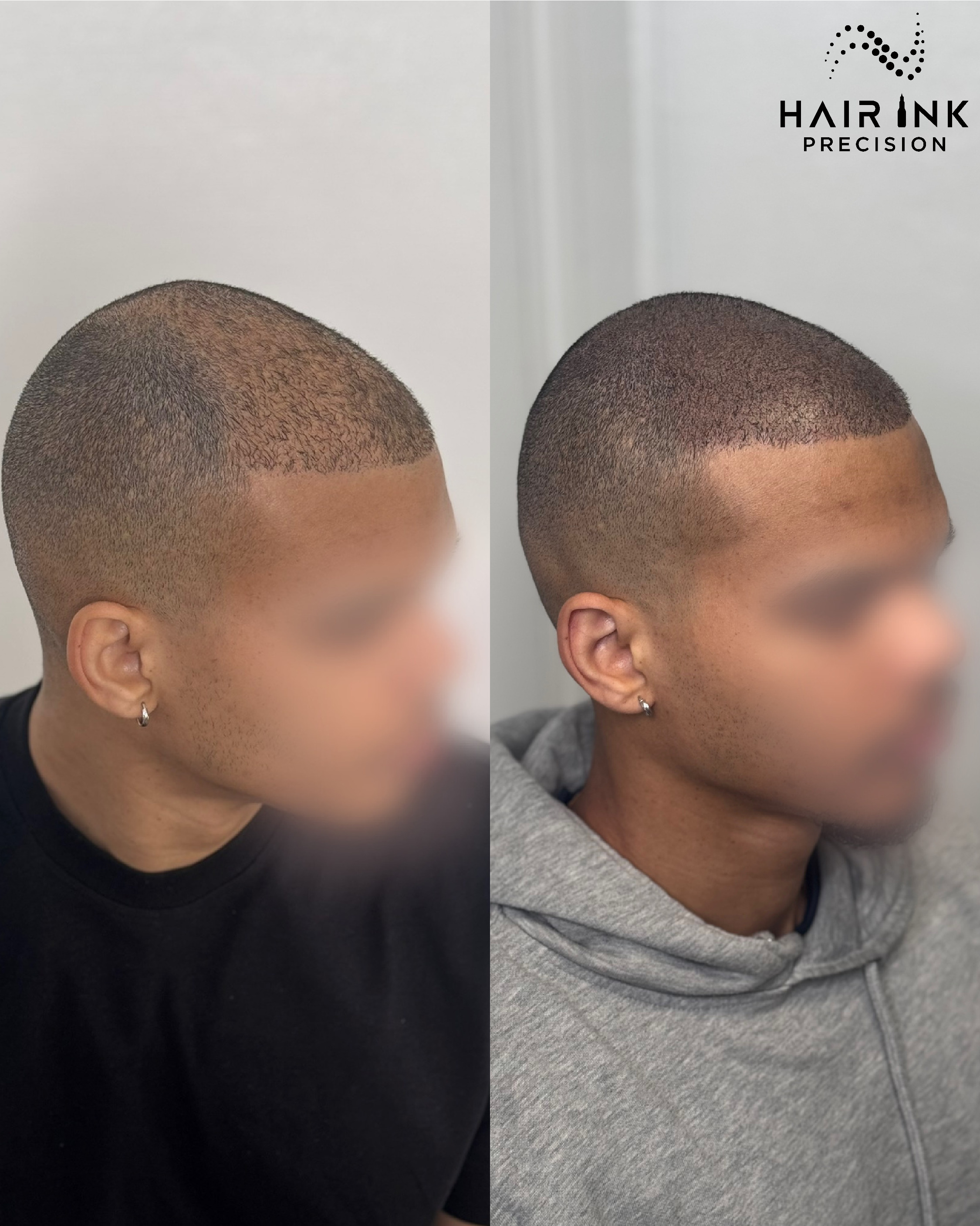 Résultat tricopigmentation