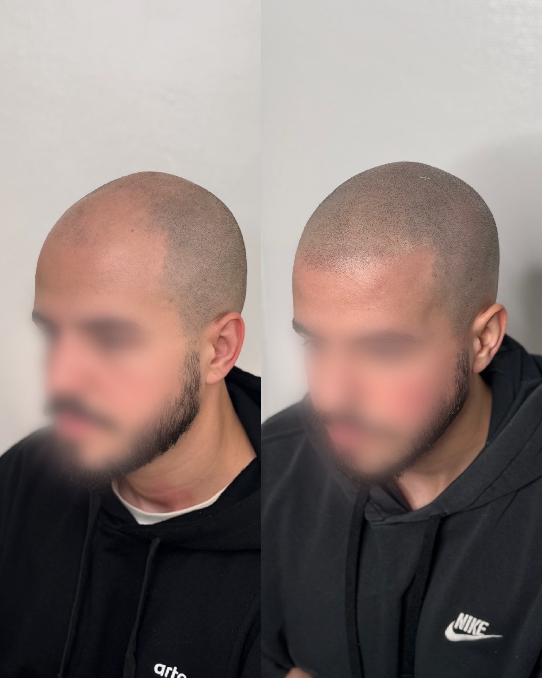 Résultat tricopigmentation